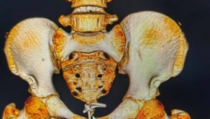12歲男孩下體插著電線就診！醫(yī)生：這些尿道異物要注意