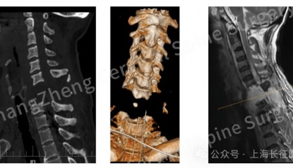 全球罕見！中國醫(yī)生救回“身首離斷”患者