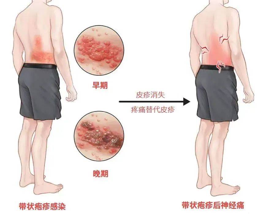一旦感染終身攜帶！深圳疾控提醒：這4類人要注意