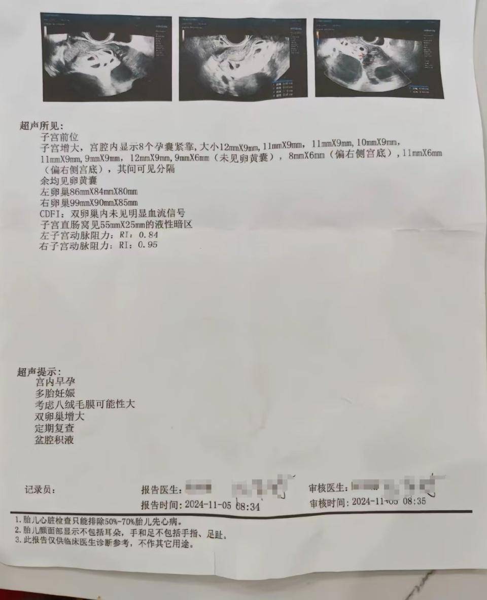 懷上9胞胎女子今日進(jìn)行減胎手術(shù)：分兩次進(jìn)行，第一次減去四個(gè)胚胎，第二次減去三個(gè)