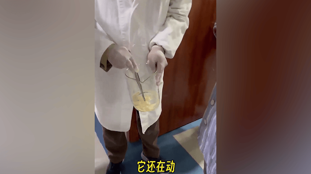 女子肛門處刺癢難忍，醫(yī)院用“南瓜籽+檳榔”驅(qū)蟲排出長達(dá)10米寄生蟲