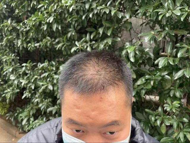 “還能反光！”長(zhǎng)沙男子植發(fā)近9月稱后腦勺“像狗啃過(guò)”