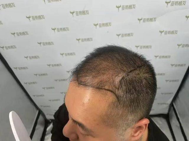 “還能反光！”長(zhǎng)沙男子植發(fā)近9月稱后腦勺“像狗啃過(guò)”