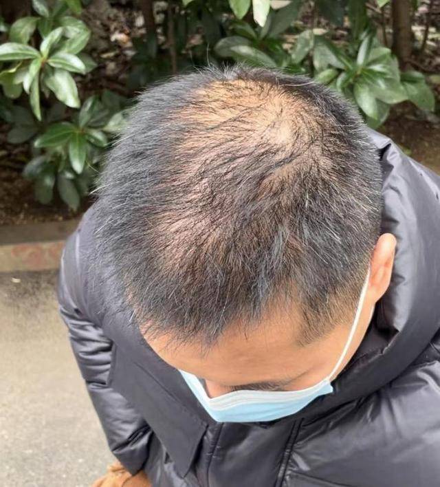 “還能反光！”長(zhǎng)沙男子植發(fā)近9月稱后腦勺“像狗啃過(guò)”