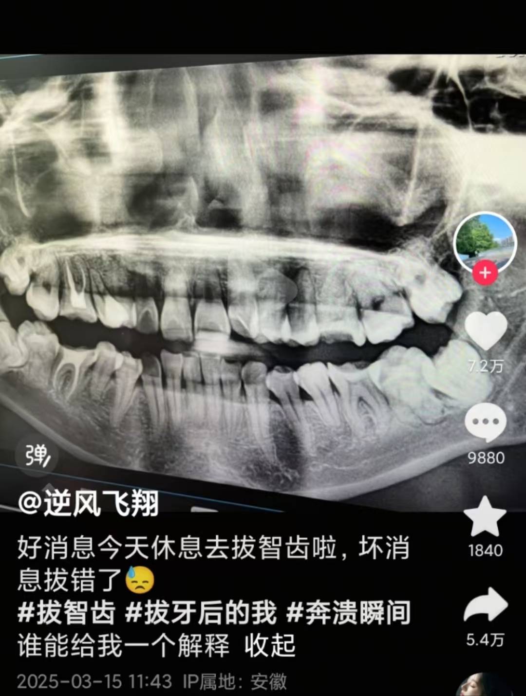 安徽一女子被拔錯牙后墜樓身亡，家屬：好牙位置沒打麻藥，硬生生拔下來