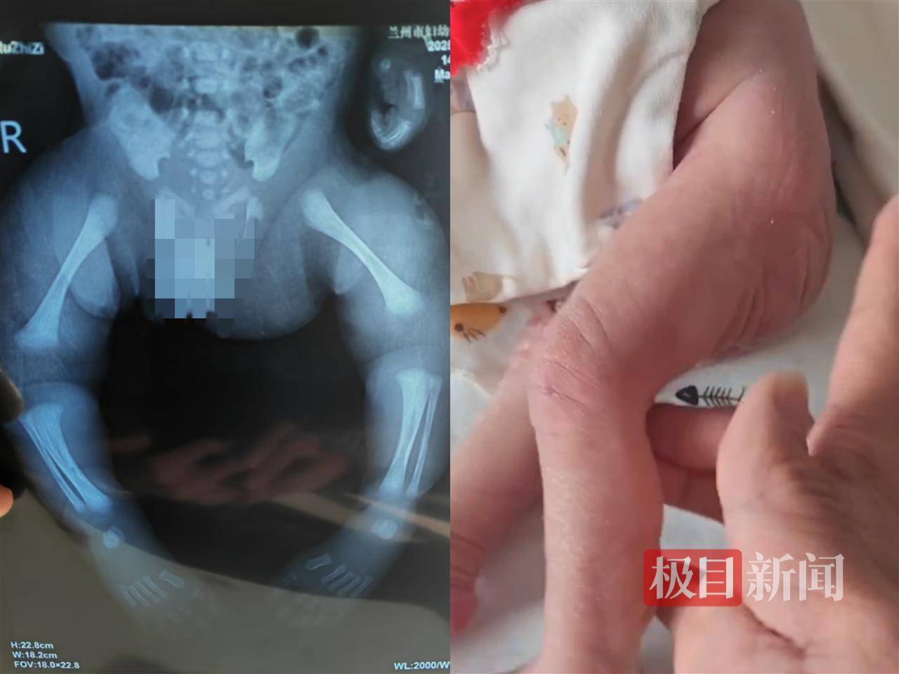 二胎出生查出先天性病癥或落下殘疾，殘疾父母稱醫(yī)院產(chǎn)檢漏檢、未盡告知義務(wù)，醫(yī)院及醫(yī)調(diào)委回應(yīng)