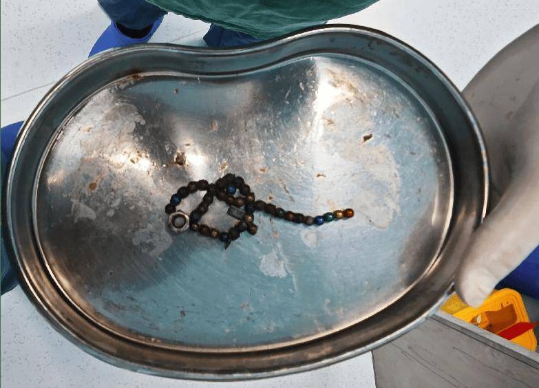 整整37顆！云南4歲孩子身體里取出……醫(yī)生緊急提醒！