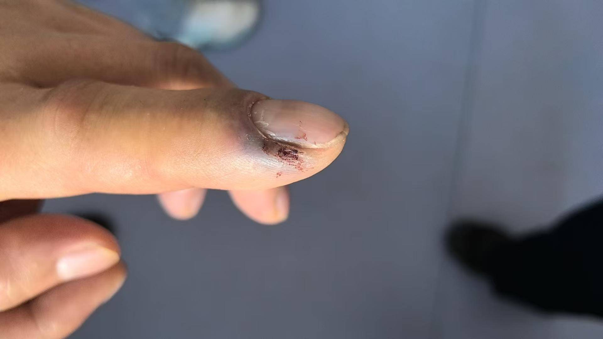 青海一男子被罕見(jiàn)劇毒阿拉善蝮蛇咬傷，因無(wú)血清一度想放棄治療 警車(chē)開(kāi)道轉(zhuǎn)運(yùn)700公里救命