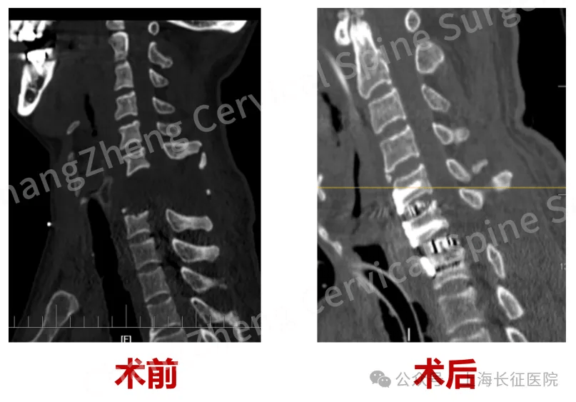全球罕見！中國醫(yī)生救回“身首離斷”患者
