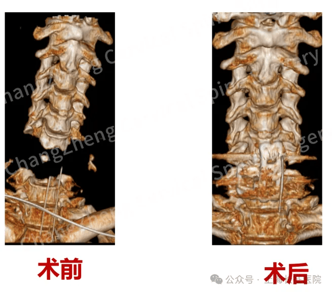 全球罕見！中國醫(yī)生救回“身首離斷”患者