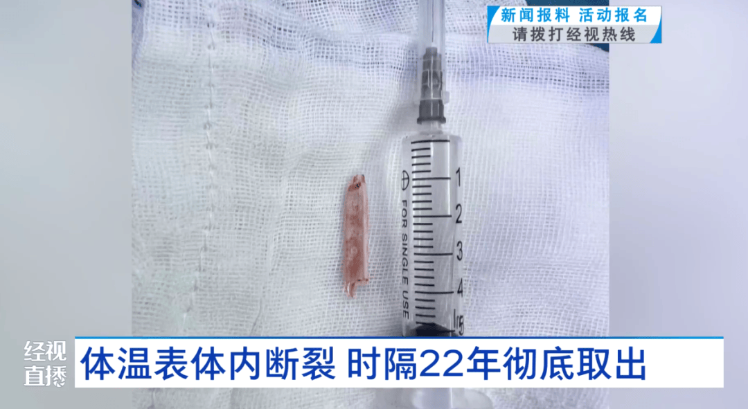 體溫表在體內(nèi)斷裂，女子時隔22年徹底取出！醫(yī)生：慶幸水銀不在里面